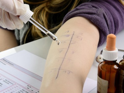 Ein Pricktest wird auf einen Arm durchgeführt