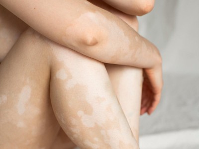 Vitiligo auf den Beinen einer Frau
