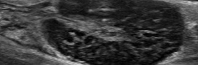 Lymphknoten mit follikulärem Lymphom