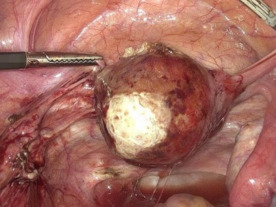 Diagnostische Laparoskopie: transmurale Nekrose nahezu des kompletten Fundus uteri