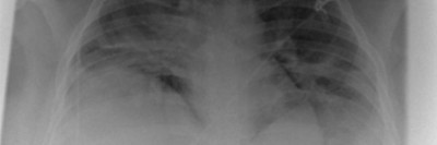 Röntgenübersichtsaufnahme des Thorax