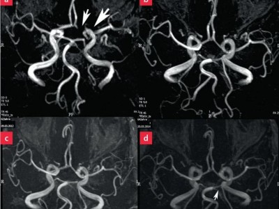 MRT-Aufnahmen jeweils der TOF-Angiografie in gleicher Projektion aus verschiedenen Jahren.