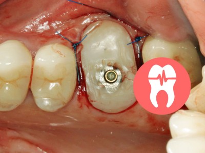Okklusale Ansicht Zahn 26: Eingesetztes Individuelles Healing Abutment. Umgebendes Weichgewebe ist mit Nähten fixiert.