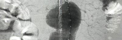 Angiogramm bei Bauchaortenaneurysma