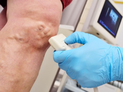 Sonografie bei Varizen