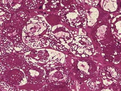 Muskelbiopsie in der PAS-Färbung mit Nachweis einer Glykogenspeicherung (Glykogenspeichererkrankung Typ II, Morbus Pompe) 