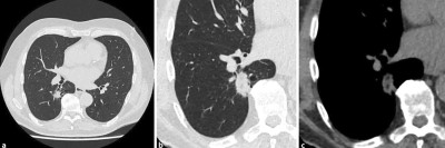 Thorax-CT ohne Kontrastmittel: spikulierter Rundherd im re. Unterlappen