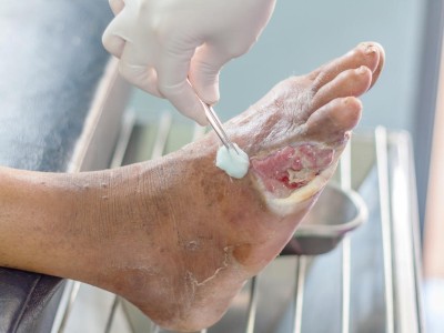 Wundbehandlung bei einem diabetischen Fuß