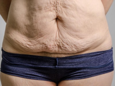 Überschüssige Haut am Bauch einer Frau nach Gewichtsabnahme