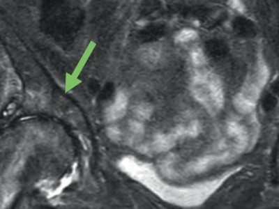 Coxarthrose rechts nach Kellgren-Lawrence-Grad III