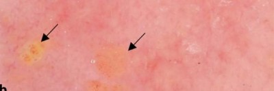 Papulopustuläre, granulomatöse Rosazea im Gesicht