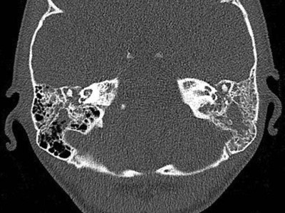 Chronische Otitis mesotympanalis beidseits