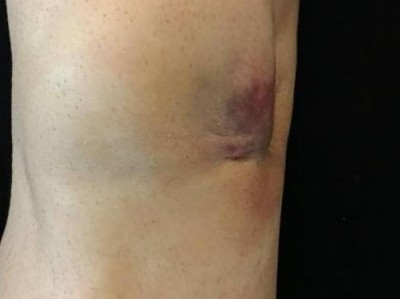 Innenseitige Hauteinziehung bei eingeschlagenem Innenband