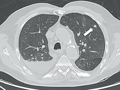 CT Thorax mit bipulmonalen, septisch embolischen Konsolidierungen