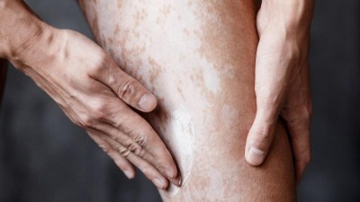Vitiligo