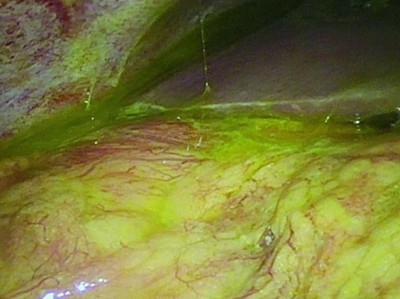 Oberbauchperitonitis