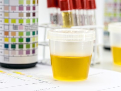 Urinanalyse zur Untersuchung von Leukozyten, Urobilinogen, Bilirubin, Blut, Nitrit, pH-Wert, Dichte, Protein, Glukose und Ketonkörpern