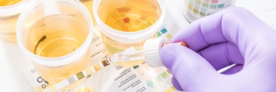 Laborkraft benetzt einen Urinteststreifen