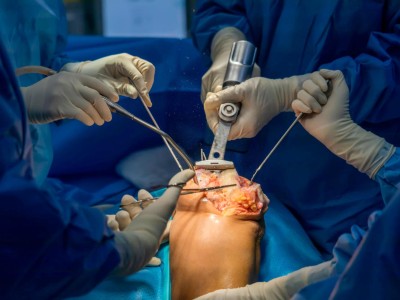 Knochensäge im Einsatz bei Knie-TEP