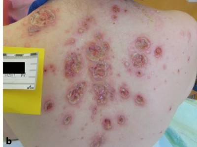 Multilokuläres Pyoderma gangraenosum an Wange und Rücken