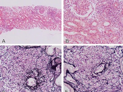 Checkpoint-Inhibitoren-assoziierte Nephritis und Vaskulitis