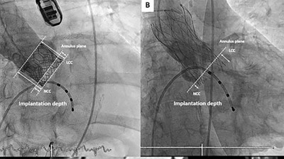 Transkatheter Aortenklappenimplantation (TAVI)