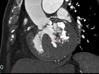 Transkatheter Aortenklappenimplantation (TAVI)