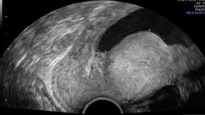 Ultraschall bei Endometriumkarzinom in der Schwangerschaft