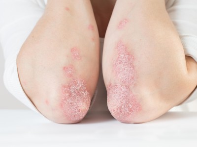 Entzündliche Plaques am Ellenbogen bei Psoriasis