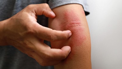 Atopische Dermatitis