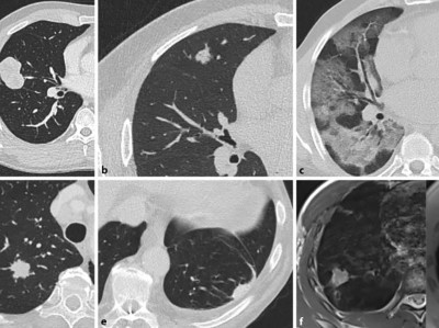 Lungenmetastasendiagnostik