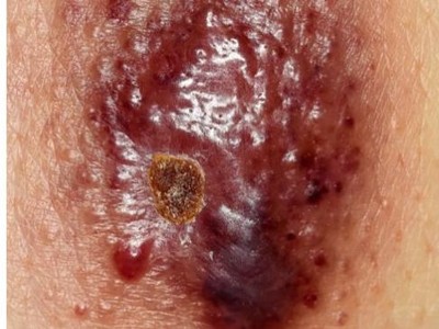 Rücken mit erythematös-lividen Makulae Plaques und Nodi 