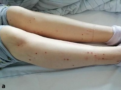 17-jährige Patientin mit familiärer intrahepatischen Cholestase