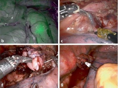 RAMIE-Operationsschritte bei Karzinom des gastroösophagealen Übergangs