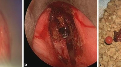 Glottisches T1b-Larynxkarzinom nach laserchirurgischer Resektion mit dem CO2-Laser