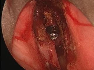 Glottisches T1b-Larynxkarzinom nach laserchirurgischer Resektion mit dem CO2-Laser