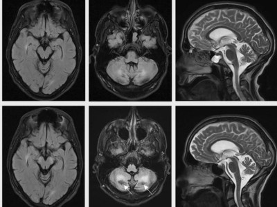 Leukenzephalopathische Veränderungen bei Zerebrotendinöse Xanthomatose