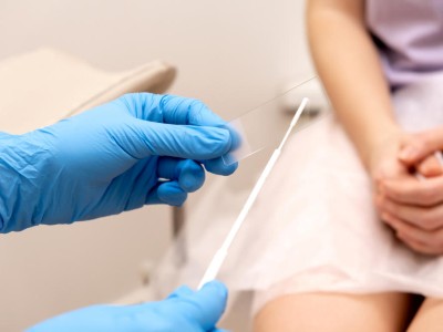 Ein Abstrich vom Gebärmutterhals wird auf ein Objektivträger geschmiert