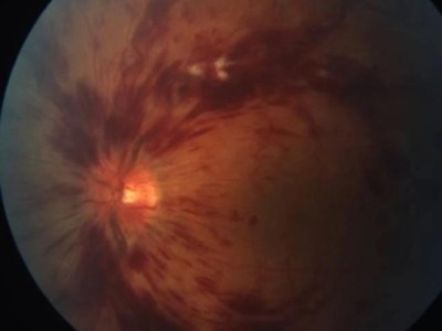 Retinale Zentralvenenthrombose