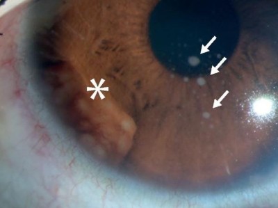 Chronische (granulomatöse) anteriore Uveitis bei Sarkoidose