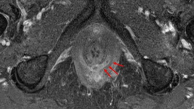 Transsphinktäre Fistel