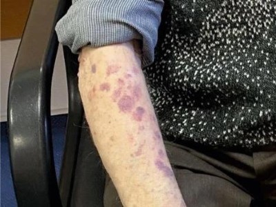 Hämatome bei Myasthenia gravis