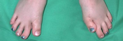Kongenitale Zehenfehlstellung („Hallux valgus“)
