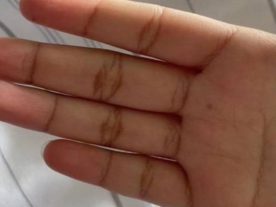 Hyperpigmentierung der palmaren Handlinien bei 16-jähriger Patientin mit Morbus Addison