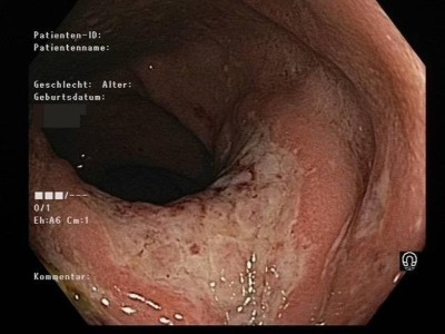 Osetin anus fotosurati