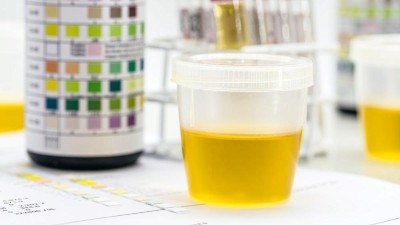 Urine sample with dipstick test