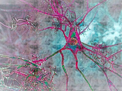 Neuron mit Amyloid-Plaques