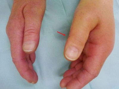 Ausgedehnten Handphlegmone