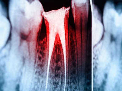 Röntgenbild einer Zahnreihe mit einem rot eingefärbten Endodont