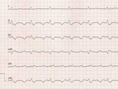 EKG bei Tachykardie